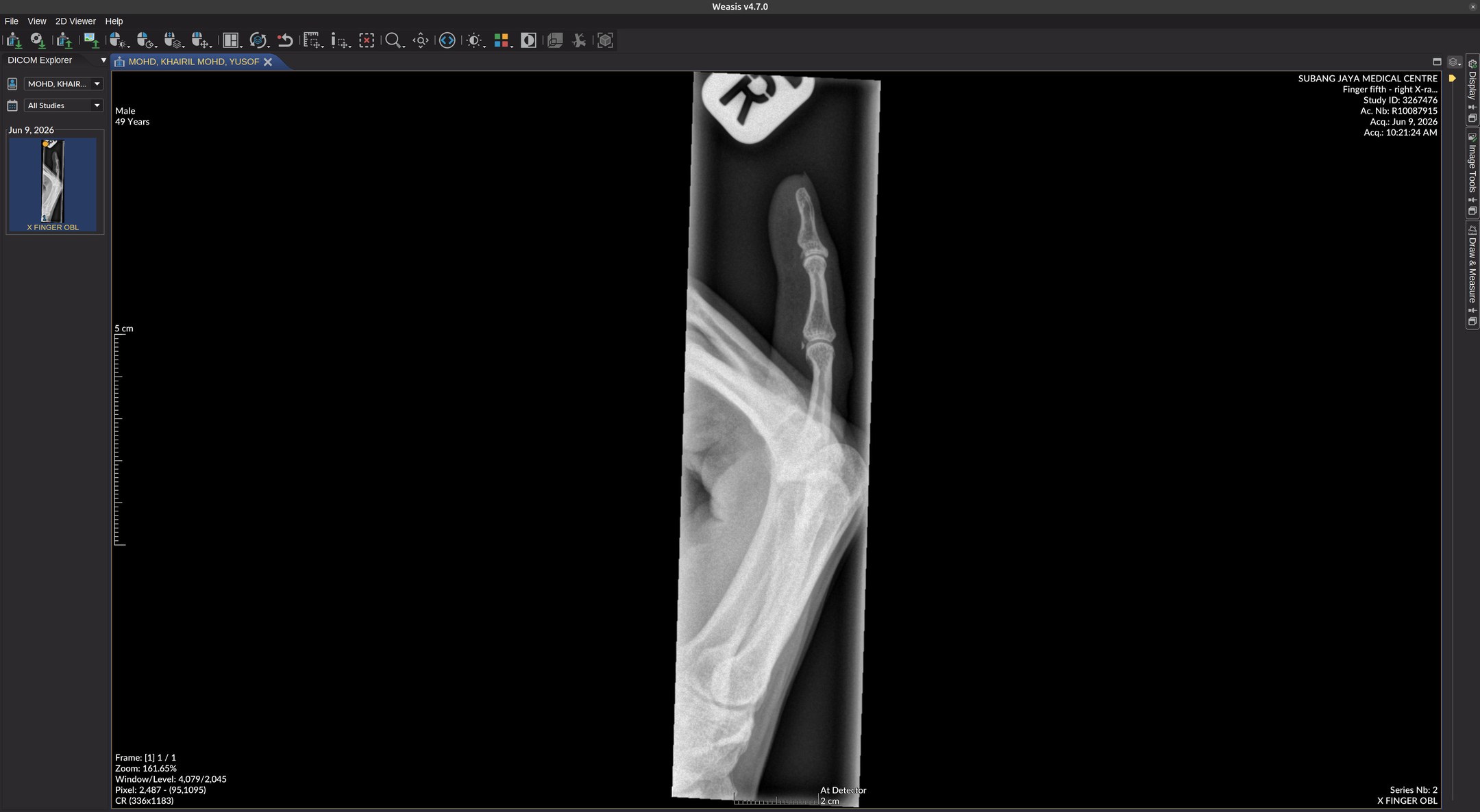 Radiograph of a right pinky finger (fifth digit) viewed on Weasis DICOM software.