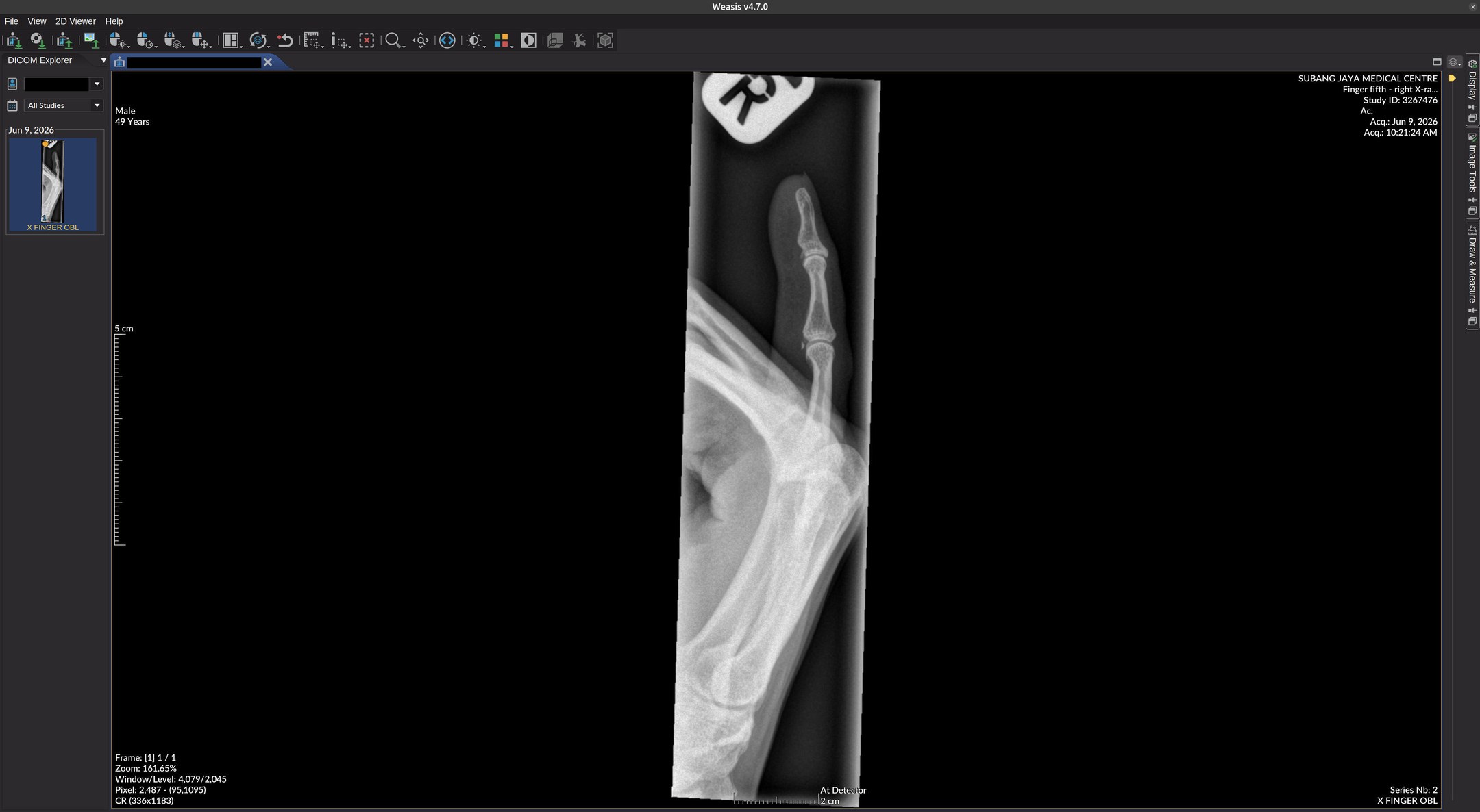 Radiograph of a right pinky finger (fifth digit) viewed on Weasis DICOM software.